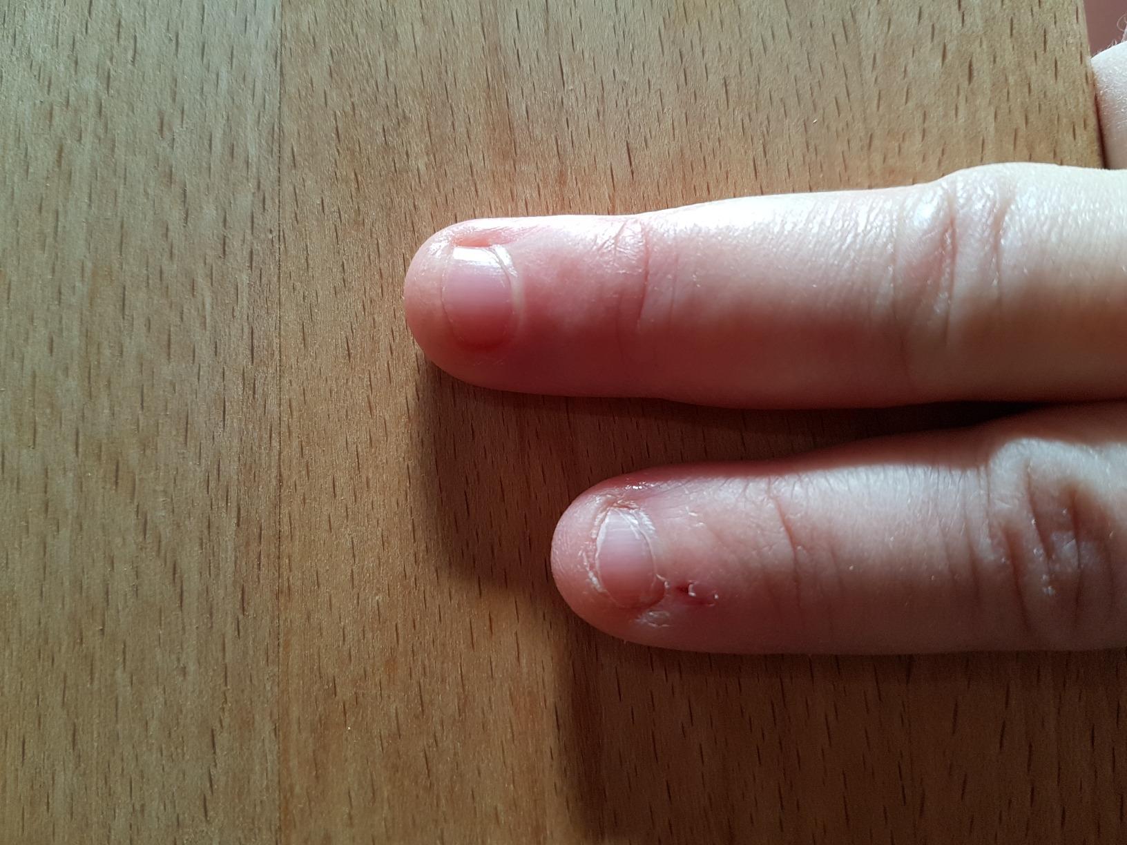 Endlich keine eingerissene Haut mehr